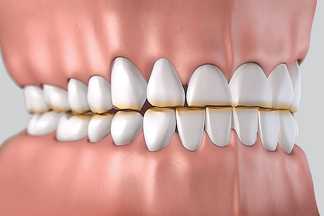 Video: the myOSA for Teeth Grinders<sup>™</sup>
