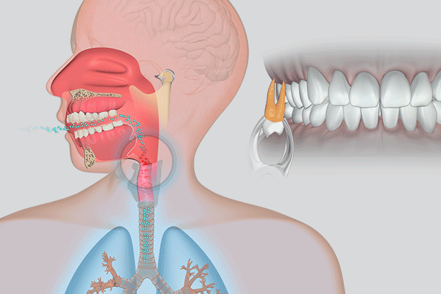 Mouth breathing is a major contributor to Sleep Disordered Breathing